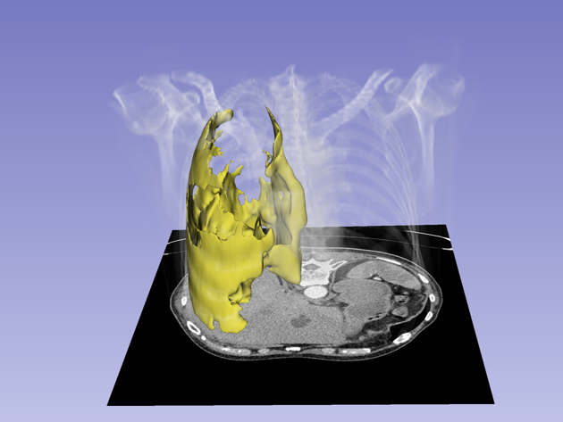 Mesothelioom P0125 All