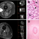Verlaging Radiotherapie