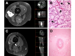 Verlaging Radiotherapie