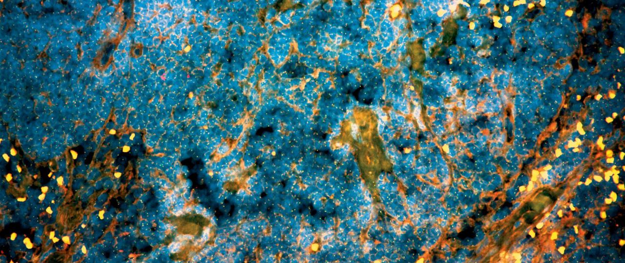 Microscopiefoto Prostaatkanker Uitgezaaid Naar Lymfeklier Patiã«Nt Copyright AVL