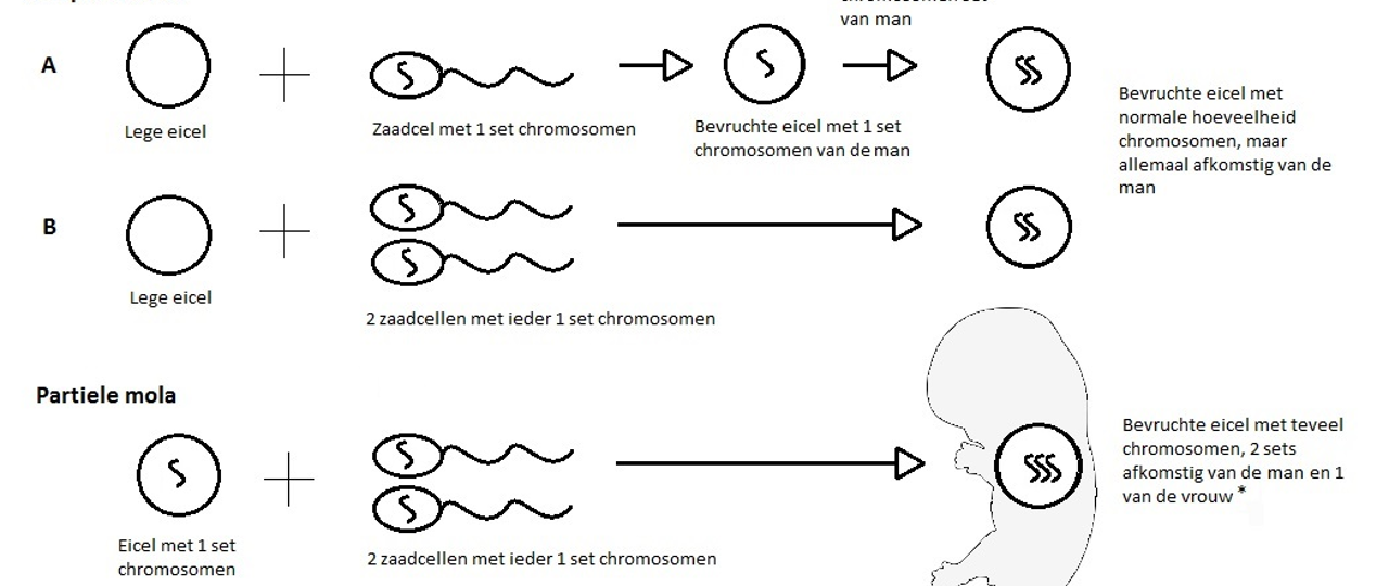 Trofoblast 2 Voorhetgesprek Mola Compleet Partieel
