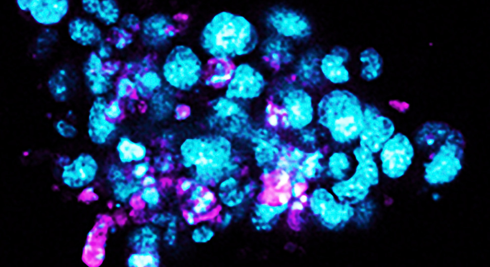 Borstkanker Organoids