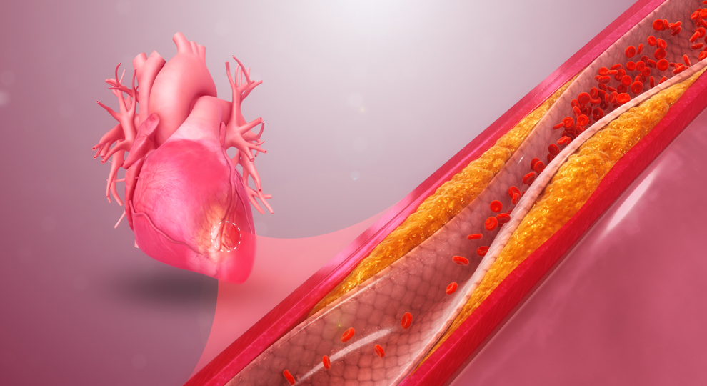 Coronary Artery Disease Wikimedia Commons Www.Scientificanimations.Com
