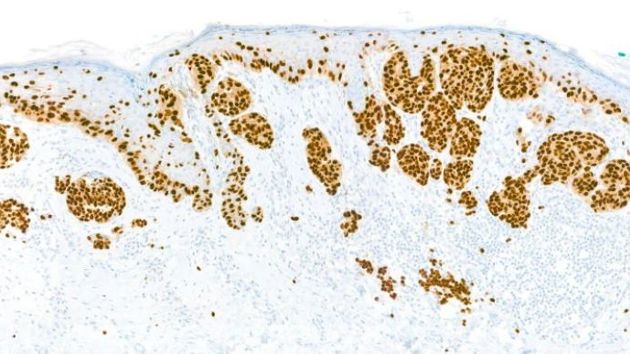 Sox 10 Ihc