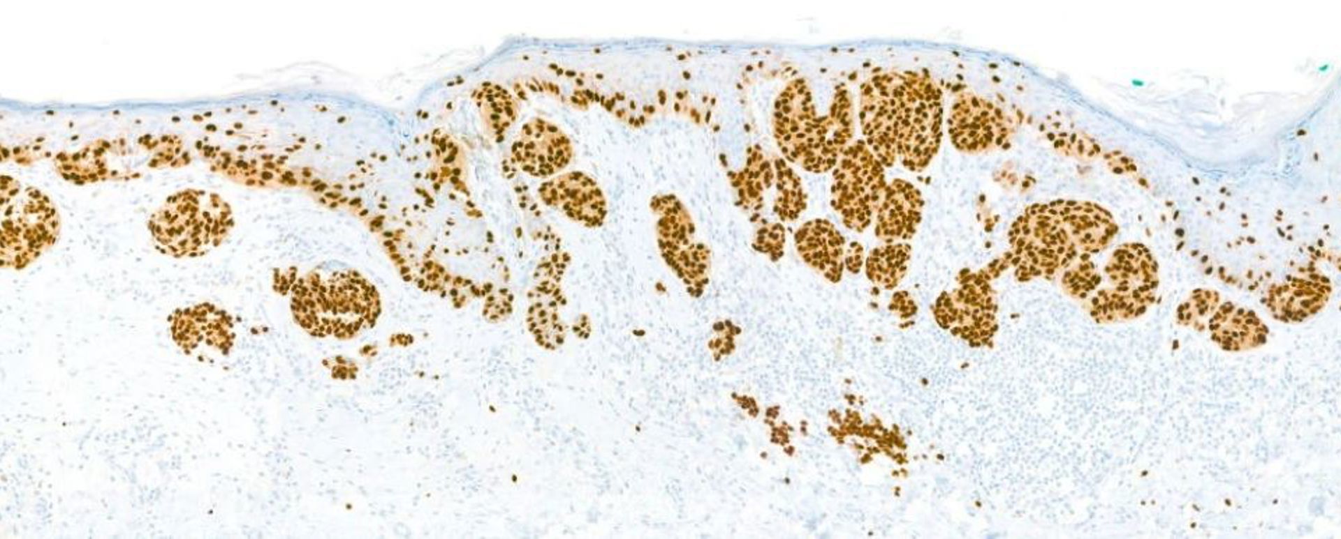 Sox 10 Ihc
