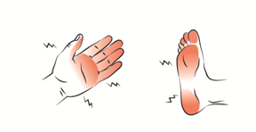 Capecitabine hand voet syndroom Knipsel