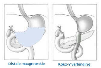 distalemaagresectie