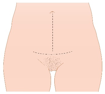 Openbuikoperatie (laparotomie)