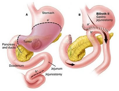 Figuur 3 Subtotale gastrectomie met Billroth II reconstructie 