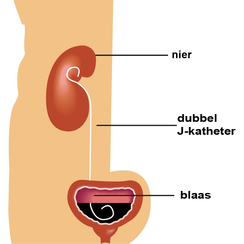 Plaatsen van een dubbel J katheter | HMC