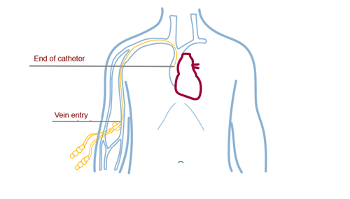 PICC line placement | Interventional radiology NKI