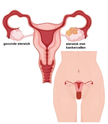 Afbeeldingsresultaat voor ovariumcarcinoom debulking