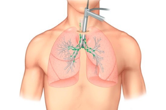 Afbeeldingsresultaat voor mediastinoscopy