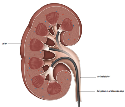 Ureterorenoscopie