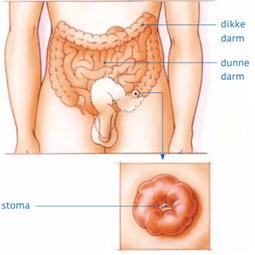 Tijdens de operatie kunnen de anus, de endeldarm en een deel van de dikke darm worden verwijderd. Aan het einde van de dikke darm wordt een stoma aangebracht. © 2013 KWF Kankerbestrijding