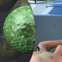Immuun En Radiotherapie AVL