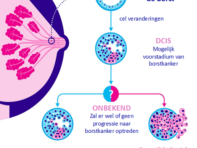DCIS Keuzehulp Infographic