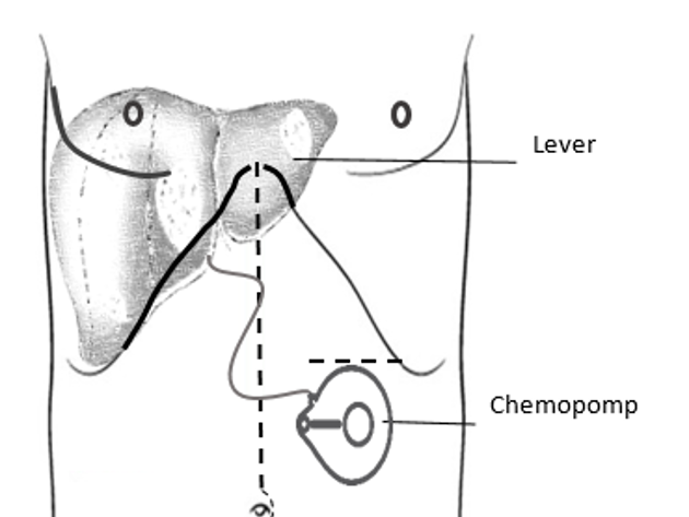 PUMP IT Chemo