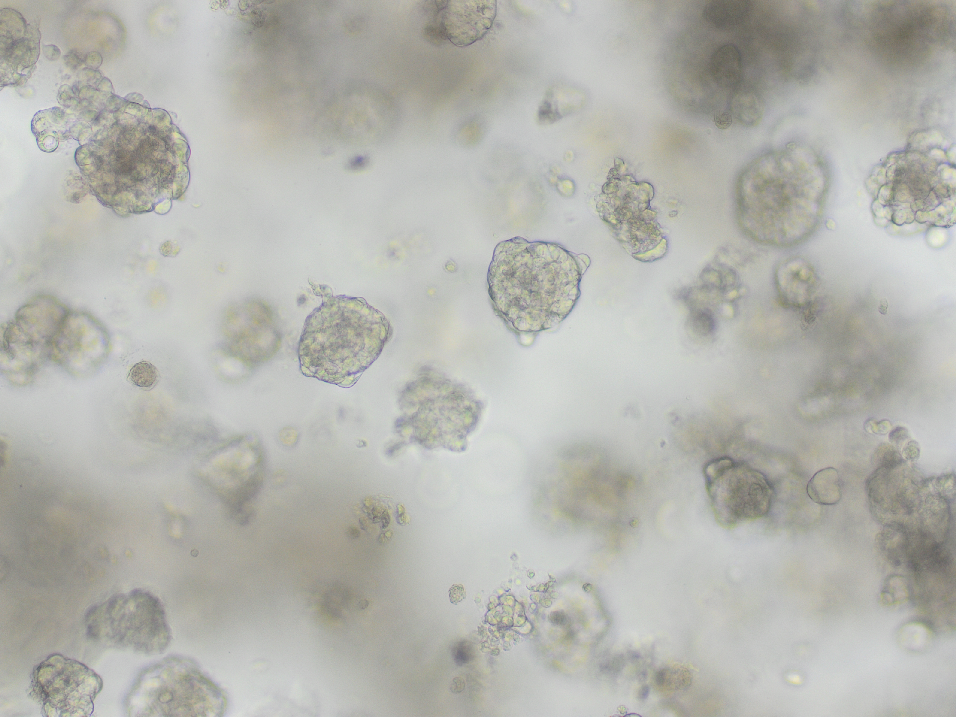 Kankercellen binnen een tumor reageren verschillend op immuuntherapie